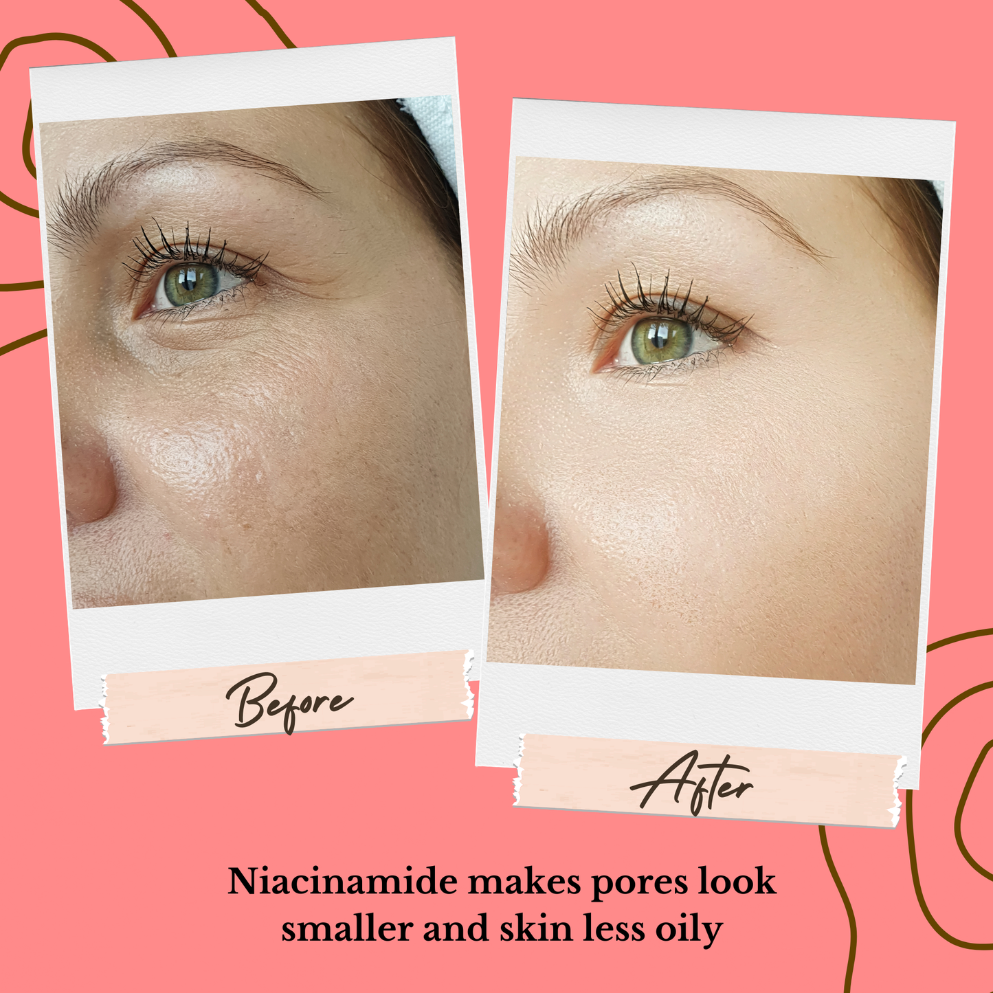 Acne Control Bundle